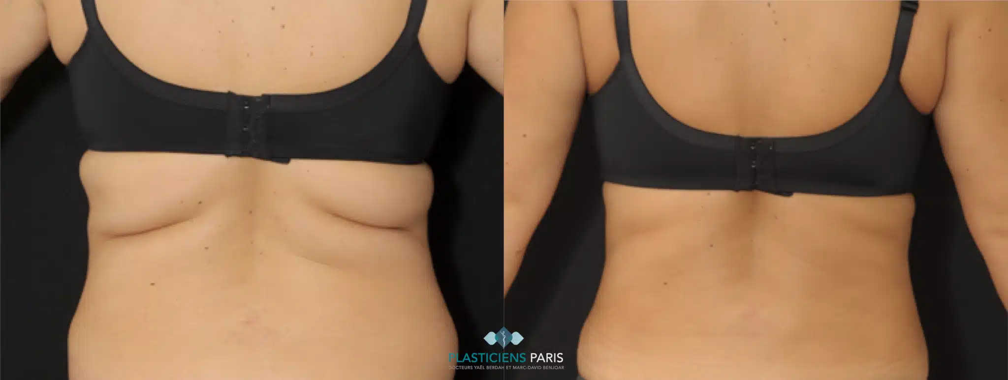 c est quoi lipo Vaser en Tunisie : Dcouvrez les Avantages et le Prix Liposuccion du ventre | Plasticiens