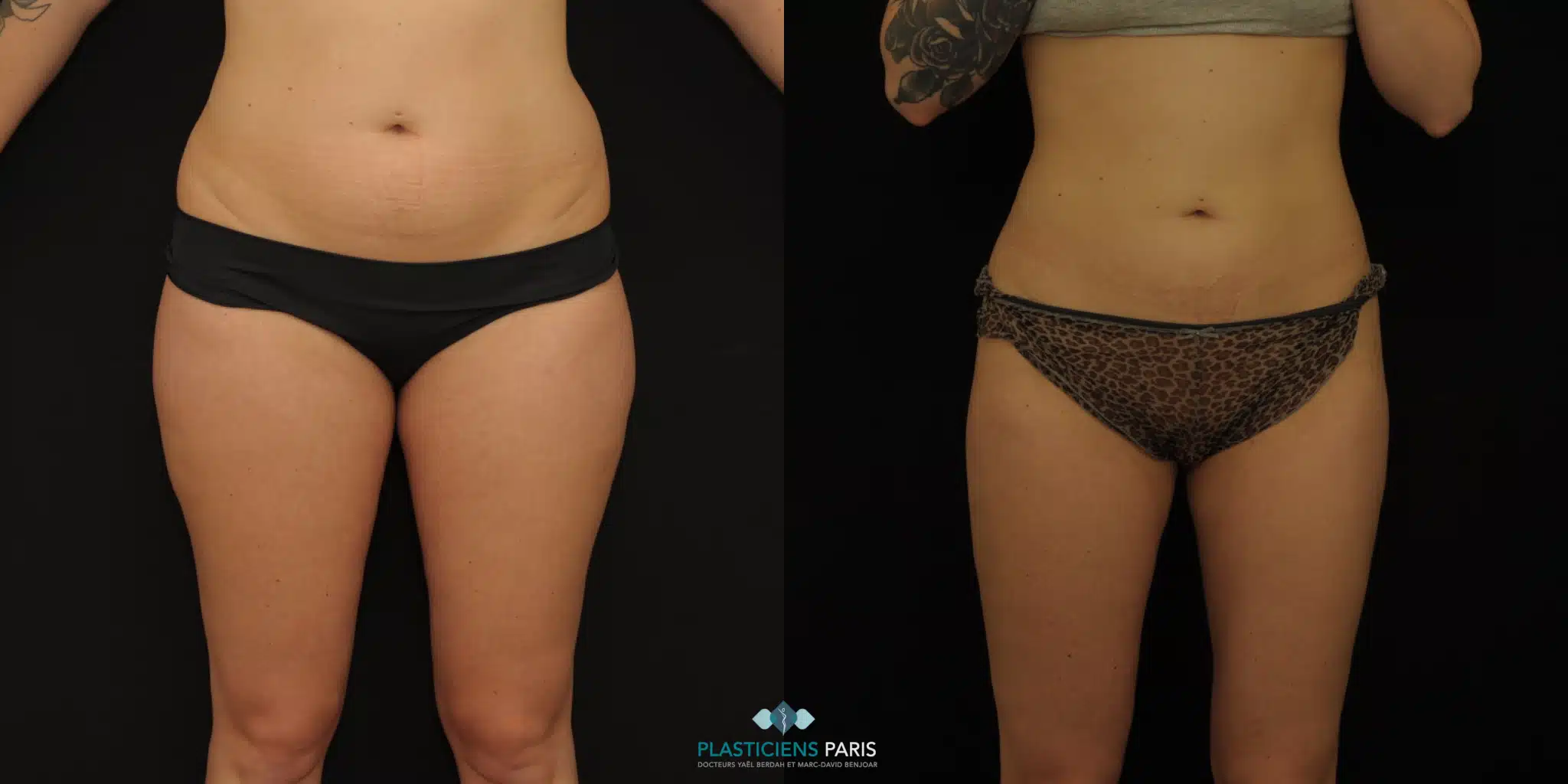 lipo c without b12 lipo c b12 para que sirve Buy Lipo-C With B12 (10 vials/kit) (100mL total)